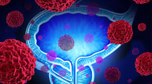 Prostate cancer